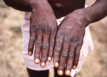 Monkeypox treatment trial begins in DRC