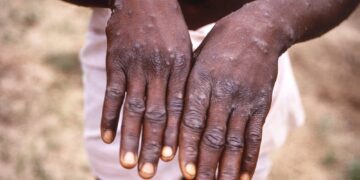 Monkeypox treatment trial begins in DRC
