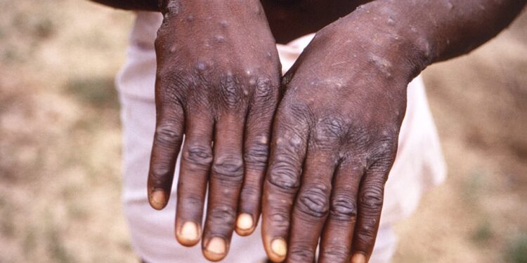 Monkeypox treatment trial begins in DRC