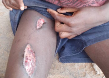 Boy (13) fights crocodile